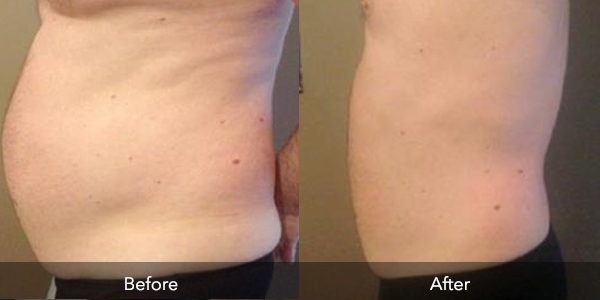 Laser Therapy | Before & After | Flawless Body