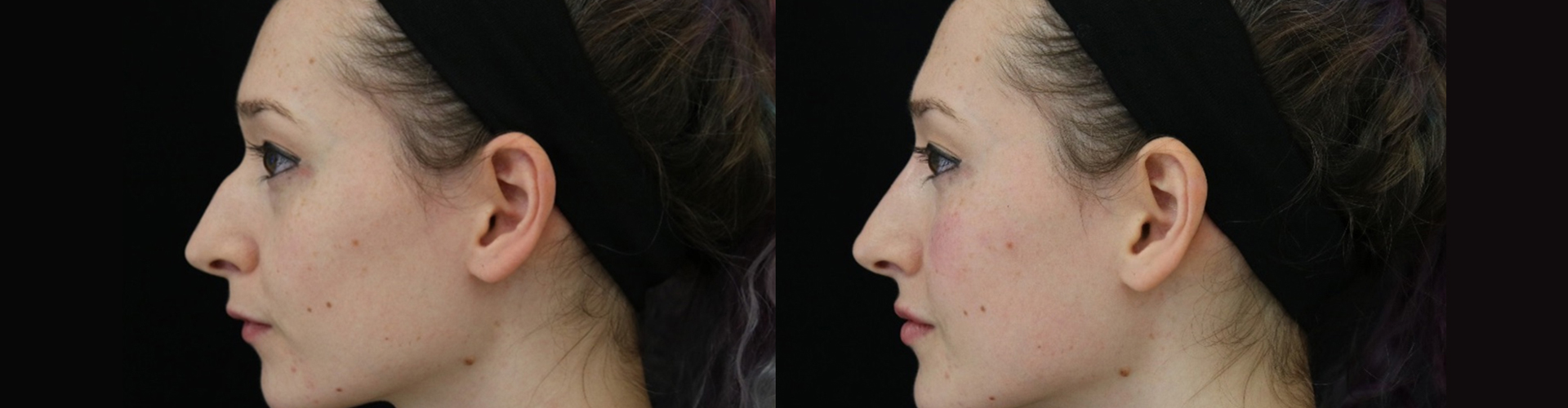 Tear Trough | Flawless Body