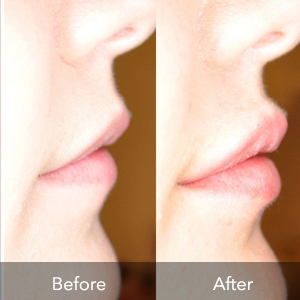 Juvederm Logo | Flawless Body