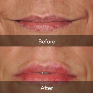 Juvederm Logo | Flawless Body