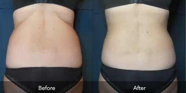 Laser Therapy | Before & After | Flawless Body