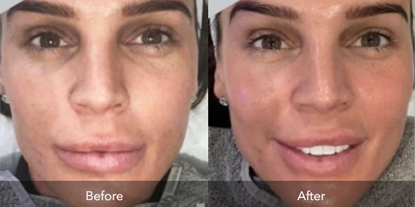 Laser Therapy | Before & After | Flawless Body