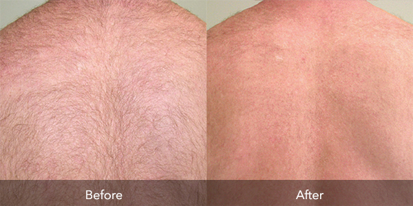 Laser Hair Removal Flawless Body Skin Laser Aesthetics