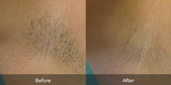 Laser Hair Removal Flawless Body Skin Laser Aesthetics