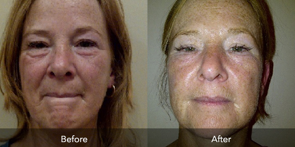 Laser Therapy | Before & After | Flawless Body