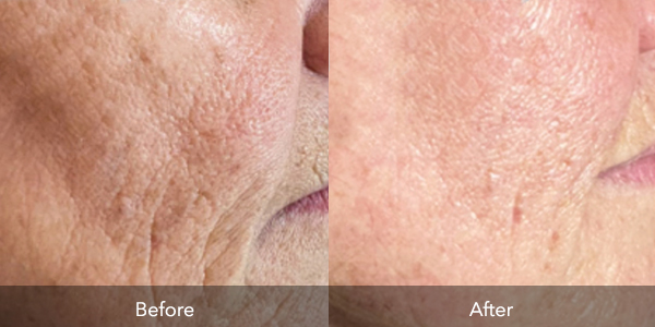 Microneedling | Before & After | Flawless Body