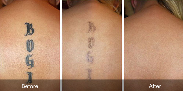 Tattoo Removal | Before & After | Flawless Body